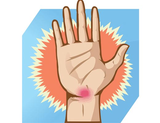 Carpal Tunnel Syndrome and Focal Dystonia